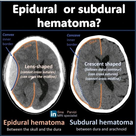 <p>Emergent surgical craniotomy / evacuation. </p>