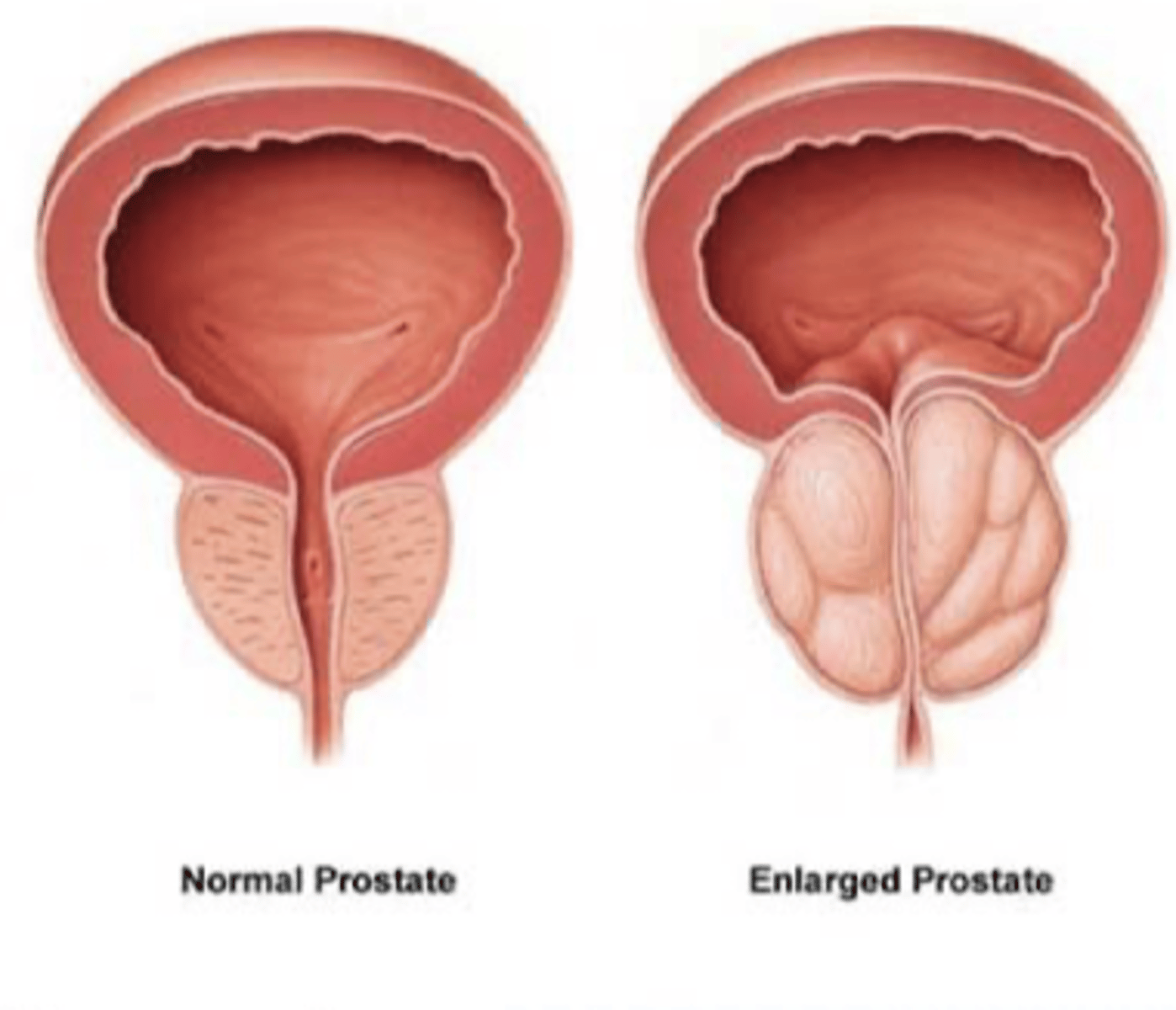 <p>Enlarged prostate</p>