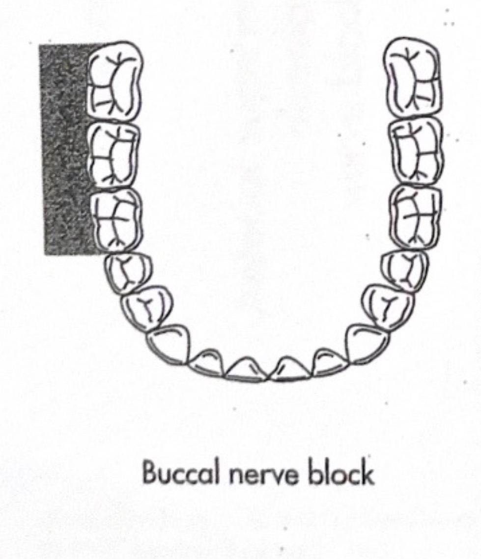 <p>Buccal nerve block (long buccal)</p>