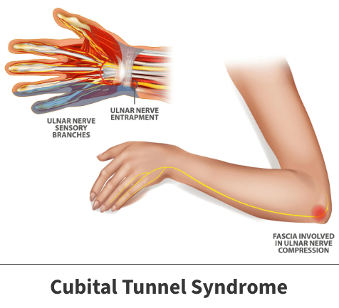 <ul><li><p>Compression of the ulnar nerve at the elbow, causing medial forearm pain and numbness in the small and ring fingers</p></li><li><p>Osborne ligament > ulnar nerve gets compressed under constant pressure </p></li><li><p>Typically presents as: </p><ul><li><p><span style="background-color: transparent;">Pain along medial forearm</span></p></li><li><p><span style="background-color: transparent;">decreased sensation along the dorsal and palmar surfaces of small finger and ulnar half of ring finger</span></p></li><li><p><span style="background-color: transparent;">weakness of RF and SF</span></p></li></ul></li></ul><p></p>