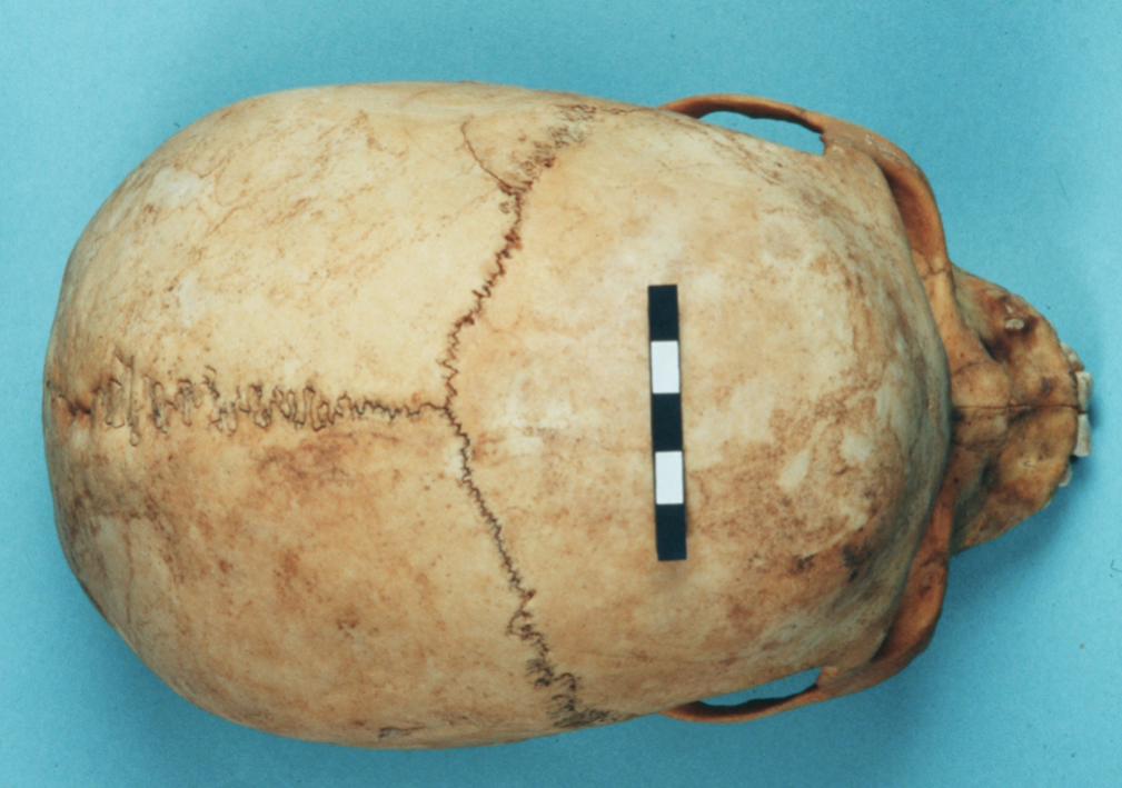 <p>what is the score for the coronal and sagittal sutures sutures of this skull (0-3)?</p>