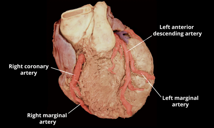 <p>Left anterior descending artery </p>