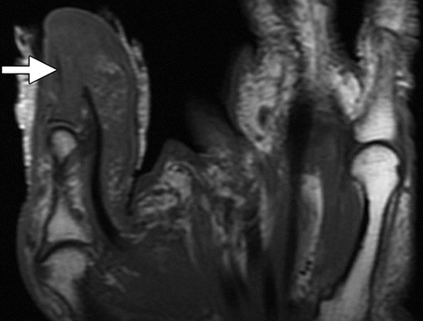 <p>Soft Tissue Infections</p>