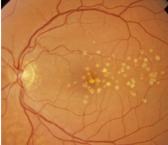 <ul><li><p>Build up of waste products from visual cycle metabolism </p><ul><li><p>Partially digested photoreceptors</p></li></ul></li><li><p>Hard drusen → Small, yellow, discreet margins <sub>(Image)</sub></p></li><li><p>Soft drusen → Large, yellow, nodules with indistinct borders</p></li></ul><p></p>