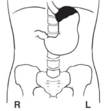 <p>What position is the patient in? Air = black. Barium = white</p>