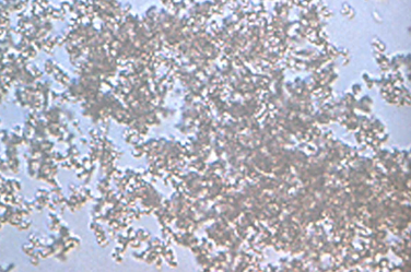 <p>Amorphous Urate Crystals</p>