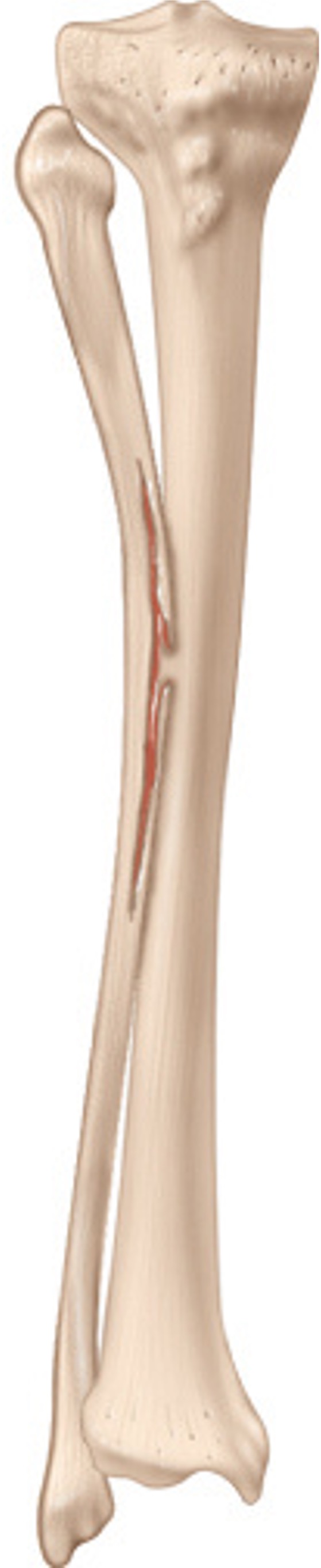 <p>an incomplete break in which the bone is bent and only the outer curve of the bone is broken</p>