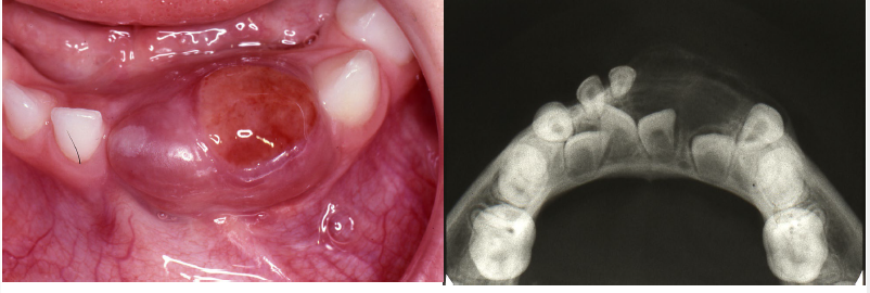<p>central giant cell granuloma</p>
