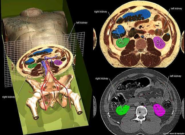 <p>3D X-ray. Best for soft tissue, bone, blood vessels. Not good for nervous or joints. Full circumference of multiple transverse cross-sections combined into computer generated image of body section. Fast, inexpensive (good for trauma situations). Some radiation exposure.</p>