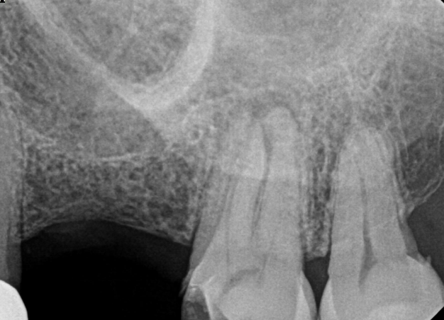 <p>What can obscure PA lesions causing difficulty to see PDL and lamina dura?</p>