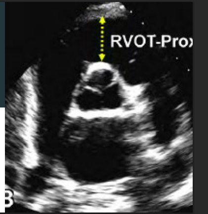 <p>Diameter measured at end diastole.</p><p>Inner edge of RV to the aortic root </p><p>Abnormal is >3.5 cm</p>
