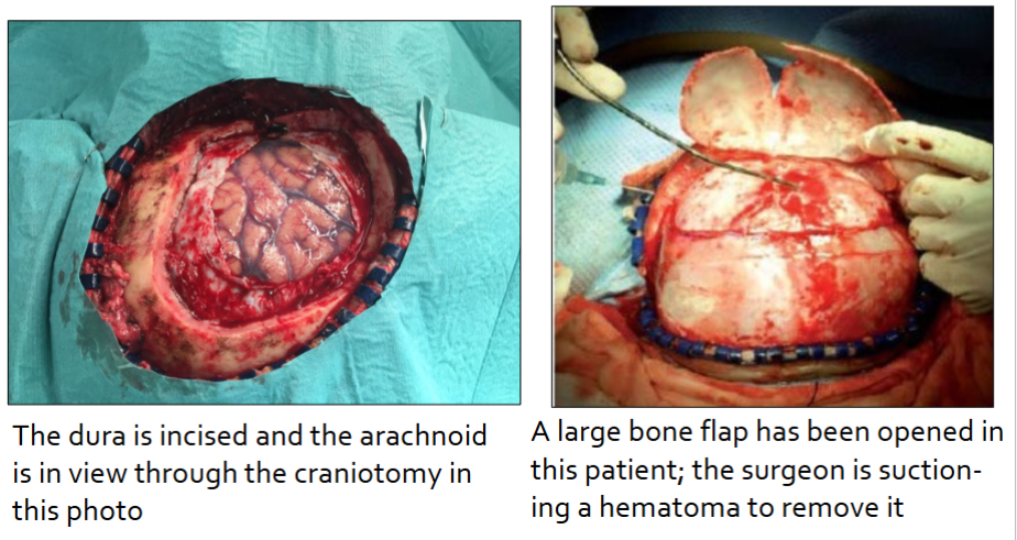 What is a craniotomy?