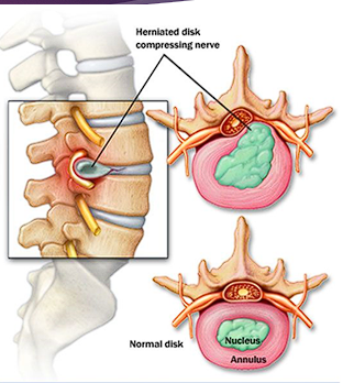 <ul><li><p>Central core of disc (jelly like center)</p></li><li><p>At birth-88% water, more cartilage than fiber</p></li><li><p>Responsible for the flexibility and resilience of the disc and column</p></li><li><p>Becomes broader when compressed</p></li><li><p>Thinner when tensed or stretched</p></li></ul><p></p>