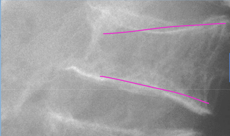 <p>A compression fracture occurs in a pt with</p>