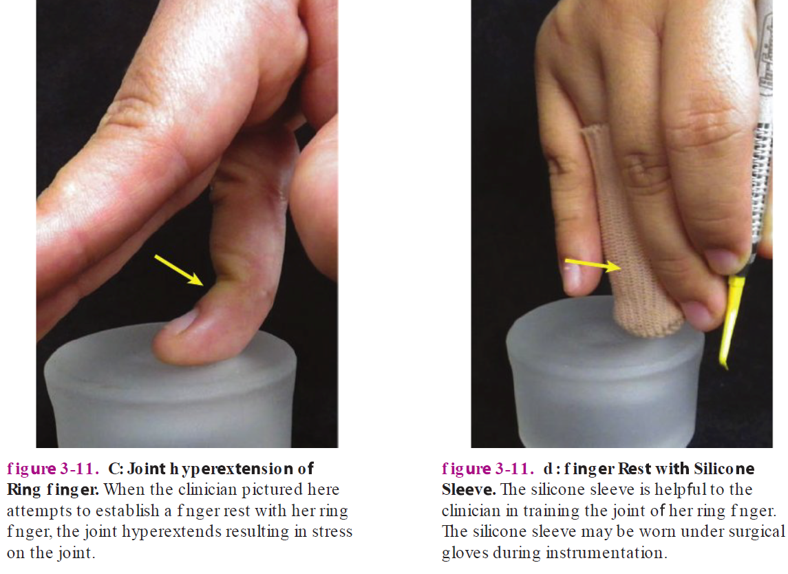 <p>Hypermobile fingers = less stable = more muscles used to grip </p><ul><li><p>Clinicians must learn to grip instruments w/o fingers collapsing inward</p></li><li><p>Reduce proprioceptive sensitivity = clinician should learn not to grip instrument w/ too much force </p></li></ul><p></p><p><strong>Lycra or </strong><span style="color: rgb(255, 0, 0);"><strong>silicon sleeve</strong></span><strong> (silipos sleeve), can help w/ proprioceptive retraining</strong></p><ul><li><p>Orthopedic hand specialist should evaluate those with pain and weakness due to joint hypermobility</p></li><li><p><span style="color: rgb(255, 0, 0);"><strong>Ring splints</strong></span> helps joint hyperextension and retrain proprioceptivity (perception) of finger position</p></li></ul><p></p>