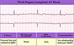 <p>a strip of p-waves laid independently over a strip of QRS complexes. Note that the p wave doesn't conduct the QRS complex that follows it.</p>