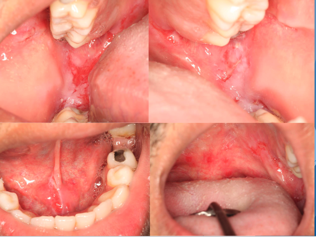 <p>• Painful chronic oral sores, dysphagia, weight loss</p><p>• Oral lesions → 50% show oral lesions first, almost all show oral lesions eventually</p><p>• Positive Nikolsky sign</p>