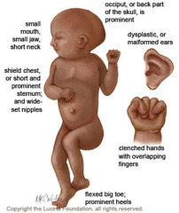 <p>- Clenched fist showing overlapping fingers</p><p>- Rocker bottom feet</p><p>- Congenital heart defects</p><p>- abnormally shaped head, low set ears, mental retardation</p><p>- More common heart/GI defects than DS</p>