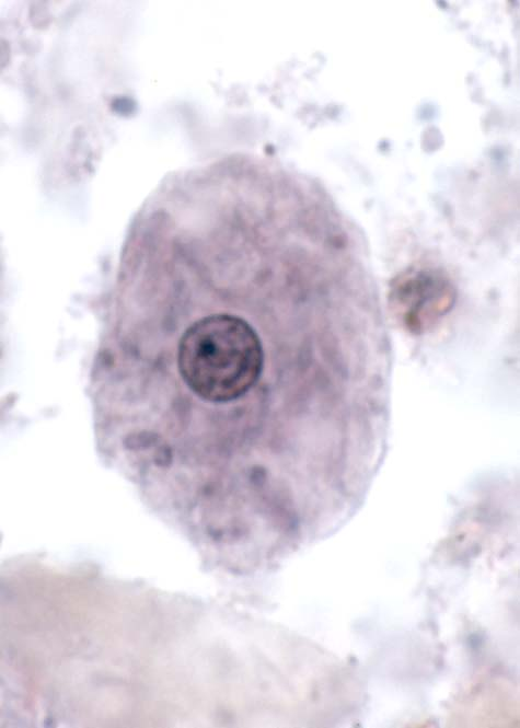 <p>12-30um, short blunt pseudopods, dirty cytoplasm/ingested bacteria, 1 nucleus with eccentric karyosome and irregular PC</p>