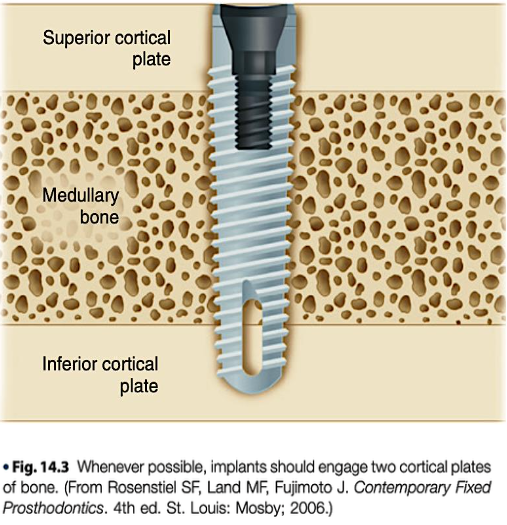 <p><span>Implant should engage two cortical plates of bone</span></p><p><span>• Utilize a long, wide-diameter implant</span></p>
