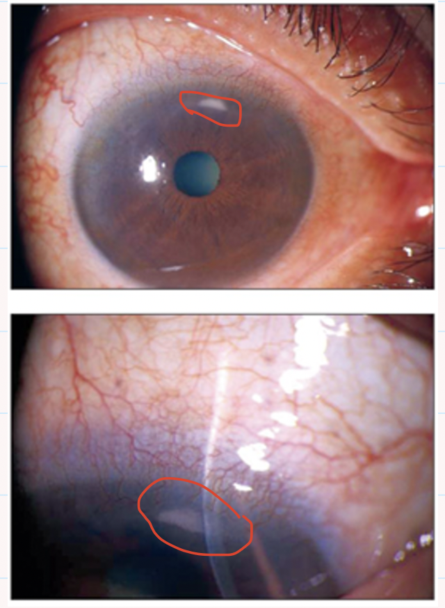 <ul><li><p>Discomfort, irritation , FB sensation </p></li><li><p>Lacrimation </p></li><li><p>Red eye </p></li></ul><p></p>