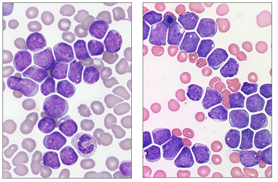 <p>- these dont hvae the hand mirror apperance other then one of them</p><p>- these are two different patients with ALL</p><p>- all the cells resemble one another (monomorphic = one morphology)</p>