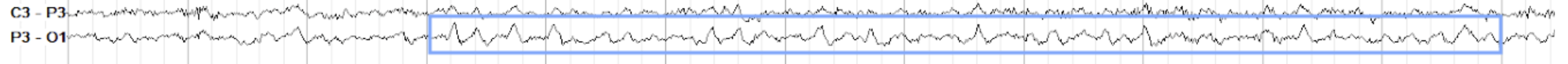 <p>occiptal electrode, sail waves</p>