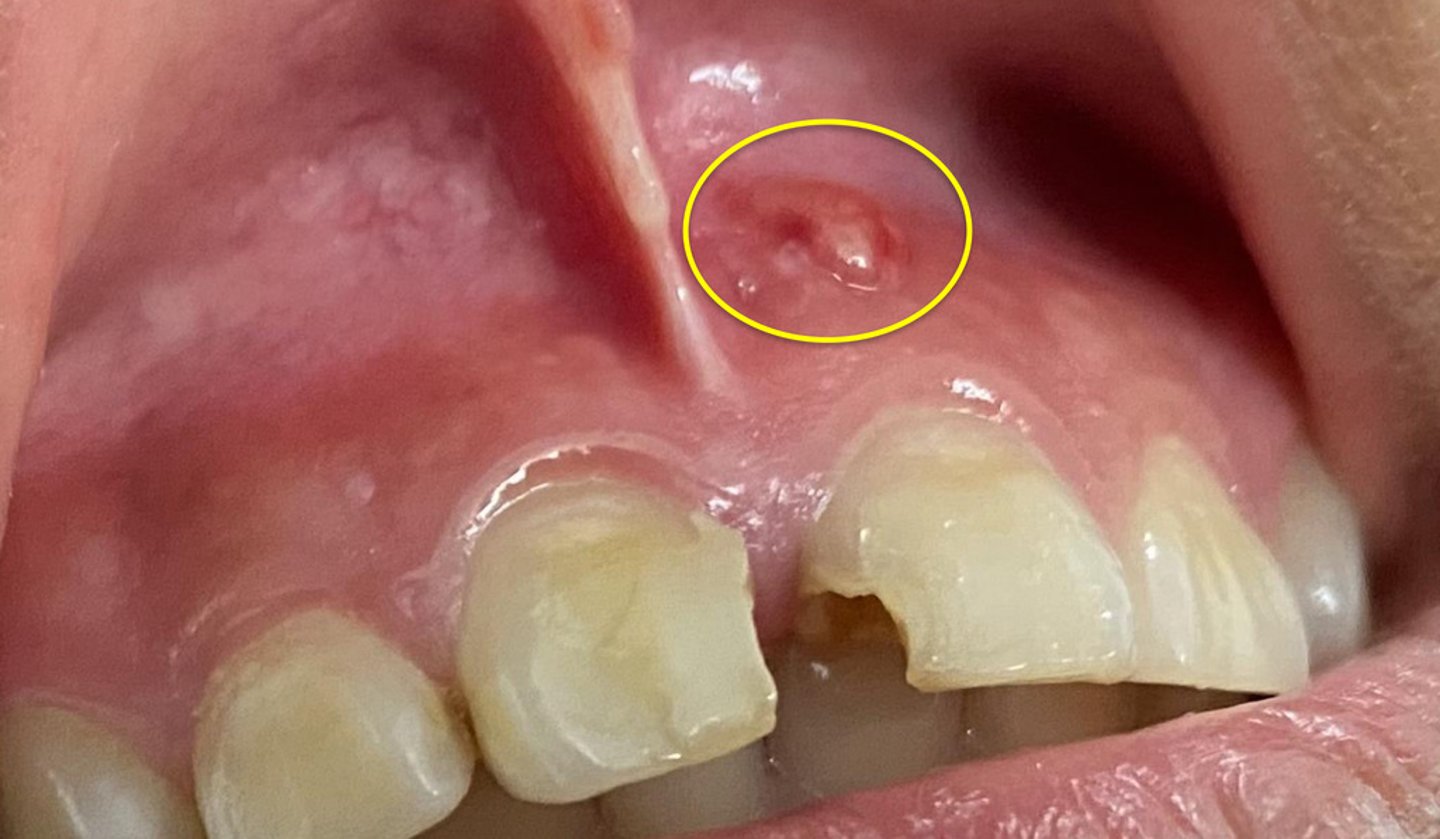<p>now have to take root out and do root canal</p>