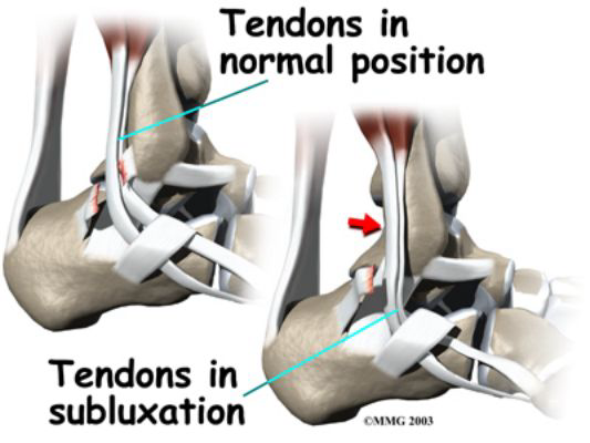 <p></p><ul><li><p><strong>Peroneal Tendon Subluxation</strong> </p></li><li><p>A tear of the peroneal tendon retinaculum can occur with an inversion ankle sprain</p></li><li><p>This causes the peroneal tendon to sublux / dislocate and move anteriorly</p></li></ul><p></p>