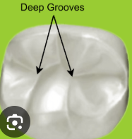 <p>Depression in tooth that is narrow and linear </p>