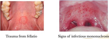<p>trauma from fellatio</p><p>signs of hemostatic disease</p><p>signs of infectious monoculeosis</p><p>trauma from severe coughing &amp; vomiting</p>