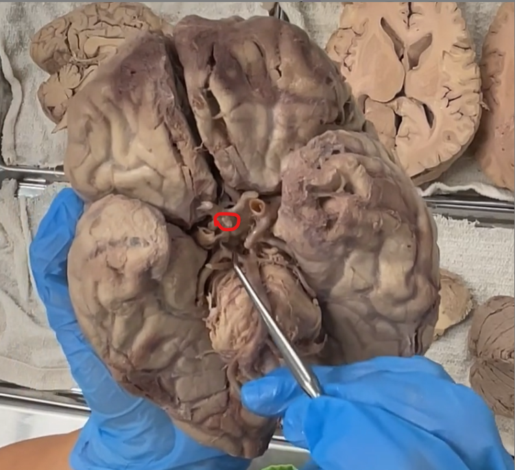 <p>pituitary stalk </p>