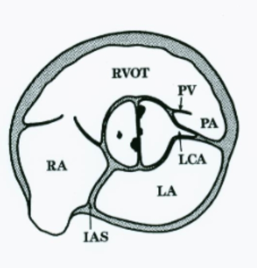 <p>PSAX Bicuspid AOV Extra </p>
