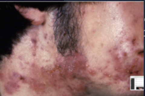 <p>Paciente masculino de 19 años de edad, sano. Acude por presentar 1 año de evolución con la dermatosis que se observa en la topografía. Refiere que empeoró cuando empezó a consumir suplementos y licuados de proteína para complementar su entrenamiento físico en el gimnasio. ¿Cuál de los siguientes tratamientos sería el mejor indicado para su paciente?</p>