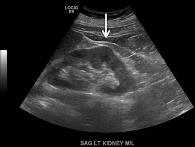 <p>A dromedary hump is usually on the ___ kidney. And the echogenicity is the ___ as the rest of the renal ___.</p>