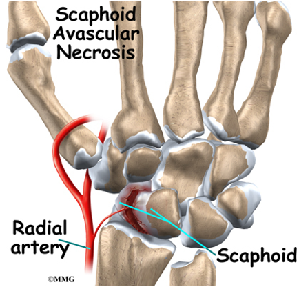 <ul><li><p>Disruption of blood flow to the bone → bone cell death, destruction/collapse of the bone, disability, pain</p><ul><li><p>Does start immediately </p></li><li><p>Can be reversible if it is dealt with in the first couple of weeks → after that it is irreversible </p></li></ul></li><li><p>Radial artery comes up and flows backwards </p><ul><li><p>The distal portion of the scaphoid had the best flow while the proximal portion has close to none </p></li><li><p>Have break midway or proximally: chances of union are very low especially if it is displaced </p></li></ul></li><li><p><strong>Osteoarthritis usually develops 10-15 years later</strong></p></li></ul><p></p>