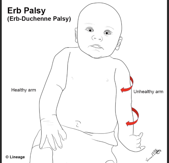 <ul><li><p>baby’s shoulder stuck behind moms pubic bone</p></li><li><p>“<span style="color: rgb(28, 155, 31);"><strong>turtle sign</strong></span>”- head goes out, in, out…etc)</p></li></ul><p>→ can cause</p><ol><li><p><span style="color: rgb(28, 143, 65);">Erb Duchenne</span> palsy (disabled arm)</p></li><li><p>uterine rupture</p></li><li><p>hemorrhage etc</p></li></ol><p></p>