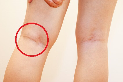 <p>popliteal</p>