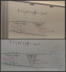 <p>P + (1/2)ρv² + ρgh = constant</p><p> * The flow of blood is horizontal.</p><p> * Let's say someone accumulates clots in the inner walls of their blood vessel. </p><p> - When blood goes through a narrow constriction (with clot), is it going faster or slower? FASTER.</p><p> - Moving faster = pressure is less at that point.</p><p> - Moving slower = pressure is greater at that point.</p><p> - As the blood is moving through, the pressure is the force of the blood on the walls of the vessel per unit area.</p><p> - The blood vessel has no vacuum - it has stuff pushing into it -> F is being exerted on the blood vessels' outer walls -> balance out.</p><p> - With narrower walls (clot), the F pushing on the wall from the outside isn't as strong at that point.</p><p> - Clot accumulating = blocks pathway completely.</p><p> * Blood vessel expands in certain area = blood is moving slower than in a normal vessel.</p><p> - Moving more slowly = bigger pressure</p><p> - The F exerted by the slower moving blood is bigger, so that region of the blood vessel expands even more, making the problem even worse -> blood vessel could rupture.</p>