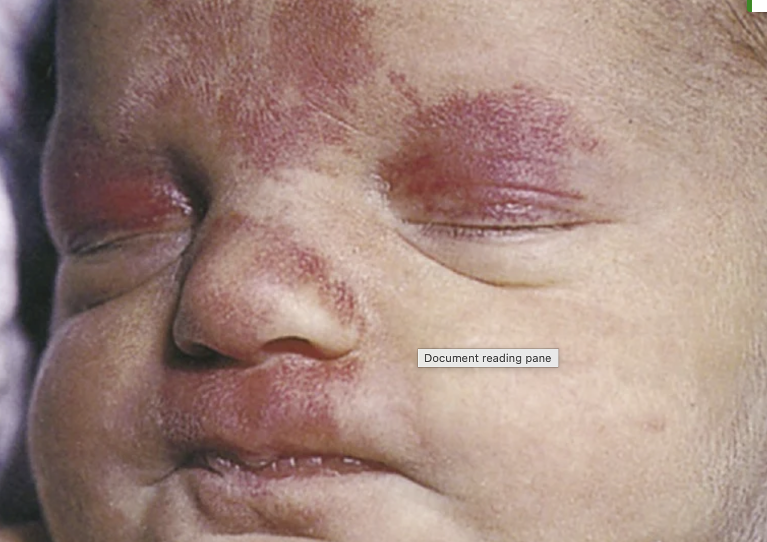 <ul><li><p>seen in 80% of newborns</p></li><li><p>superficial capillary defect </p></li><li><p>aka stork bite</p></li><li><p>usually small, flat, and pink and are easily blanch-able </p></li><li><p>common sites are the upper eyelids, nose, upper lip, and nape of the neck. </p></li></ul><p></p>