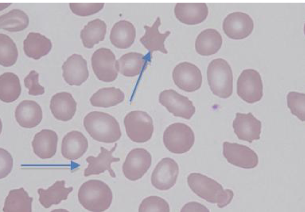 <p>Acanthocytes </p>