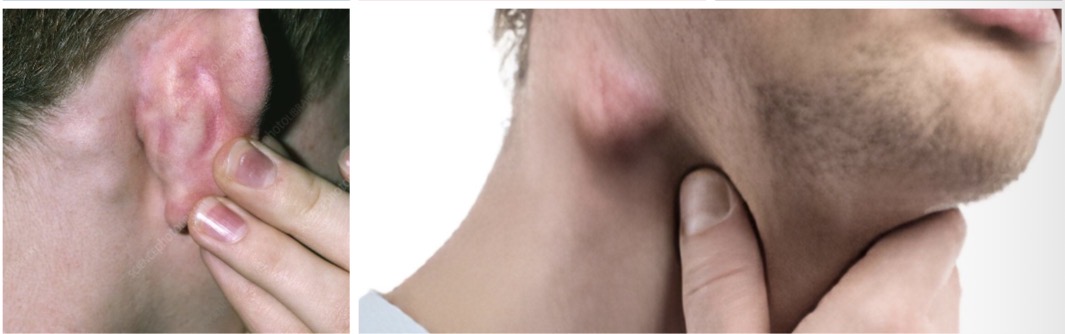 <p>Tai limfmazgiu patinis mas ir padidejimas</p><p><span><span> Lokalios limfadenopatijos priežastys: vietinė infekcija, dantų infekcija, katės įdrėskimo liga, onkologinės ligos ir kt.</span></span></p><p><span><span> Generalizuotos limfadenopatijos priežastys yra sisteminės infekcijos (pvz.: ŽIV), autoimuninės ligos, išplitusios onkologinės, hematologinės ligos,mhistiocitozė, reakcijos į medikamentus ir kt</span></span></p>