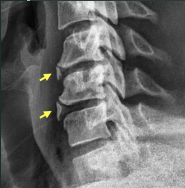 <p>Teardrop Burst Fx</p>