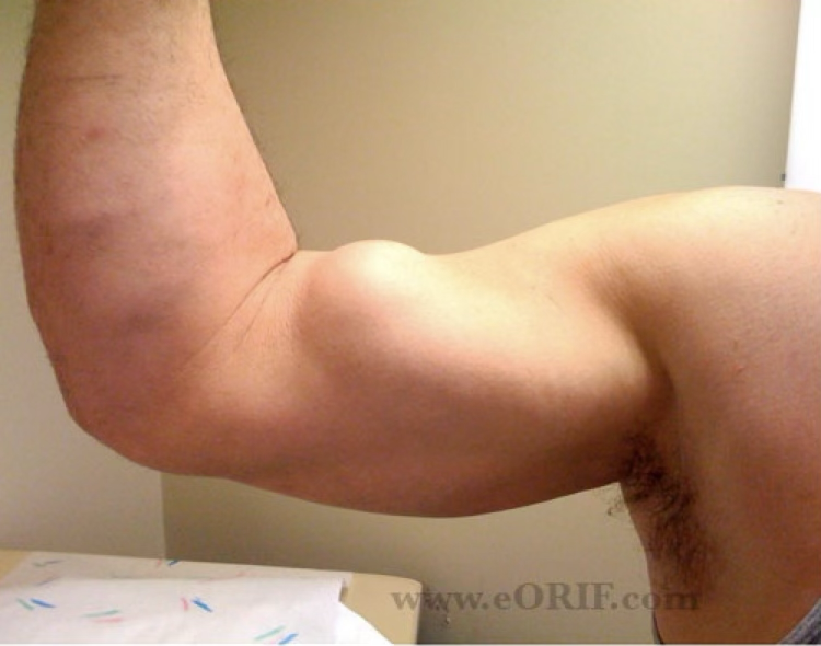 <p>biceps tendon rupture occurance &amp; symptoms</p>