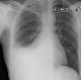 <p>this x-ray has an example of a sign of pleural effusion: what is it?</p>