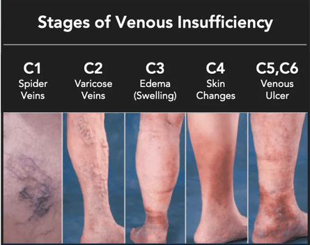<p>leg pain</p><p>edema</p><p>skin changes in ankle region</p><p>spider veins</p><p>varicose veins</p><p>healed skil ulcers</p><p>open skin ulcers </p>