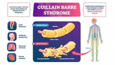 <p>Autoimmune disorder causing rapid nerve demyelination.</p>