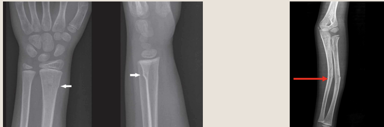 <p>name each type of shape fragments of <strong>incomplete</strong> fractures</p>