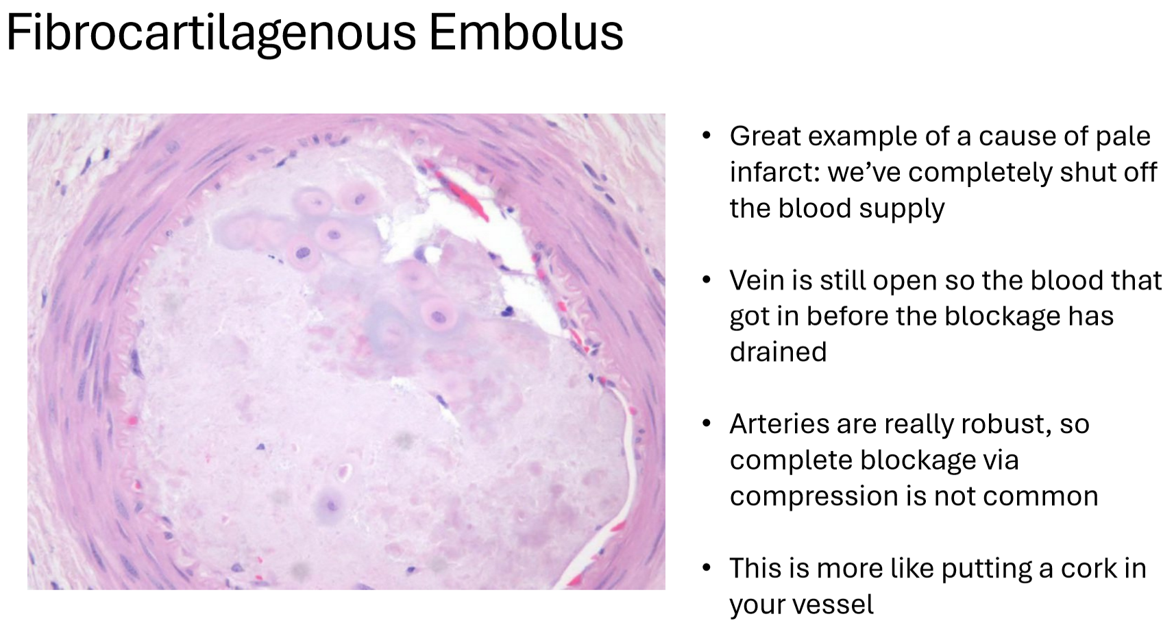 <p>1: seeing macro compression (hemorrhage), indicates there’s microscopic compression too which indicates the edema cycle (ischemia) is going on!</p><p>the combo of physical compression + ischemia can lead to <strong>infarction</strong>!</p><p>.</p><p>2: no!</p><p>.</p><p>3: red indicates the infarct started as hemorrhage or congestion of blood (usually bc of venous blockage)</p><p>pale indicates infarct was caused by arterial blockage = no blood could enter the tissue (e.g. fibrocartilagenous emboli)</p><p>.</p><p>4: arteriospasm, vasculitis, embolism, vascular compression</p>