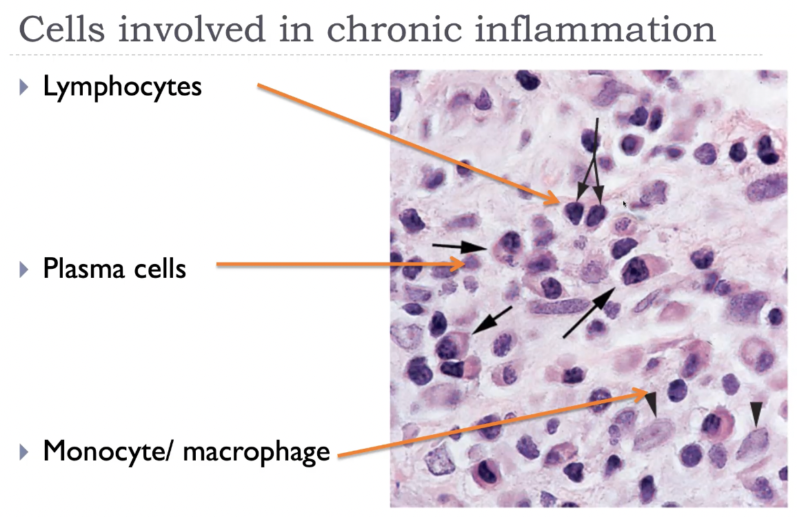 <p>Other cells involved in chronic inflammation</p><ul><li><p>Eosinophils:</p><ul><li><p>Parasitic infection and allergic reactions.</p></li><li><p>Granules release major basic protein toxic to parasites and causes epithelial cell necrosis.</p></li></ul></li><li><p>Mast cells</p><ul><li><p>Acute and chronic inflammation.</p></li><li><p>Early vascular change in acute inflammation (histamine, leukotrienes).</p></li><li><p>Allergic reaction (IgE).</p></li></ul></li><li><p>Neutrophils</p><ul><li><p>Although a hall mark of acute inflammation maybe present in some forms of chronic inflammation.</p></li></ul></li></ul><p></p><p>Chronic inflammation is characterised by infiltration of <strong>macrophages</strong>, <strong>lymphocytes</strong>, and <strong>plasma cells</strong>, with contributions from <strong>eosinophils</strong>, <strong>mast cells</strong>, and sometimes <strong>fibroblasts</strong> during repair. Macrophages are the central players: they secrete cytokines, present antigen, destroy tissue, and stimulate fibrosis. Lymphocytes (especially CD4⁺ T cells) orchestrate the immune response, while plasma cells produce antibodies. Eosinophils dominate in parasitic infections and allergy, and mast cells contribute to vascular changes and IgE‑mediated reactions. Together, these cells create a cycle of <strong>inflammation → tissue injury → repair</strong>, which defines chronic inflammation.</p>